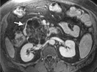87 ms) during the portal-venous phase of the dynamic study following gadolinium-chelate administration, serous cystadenoma shows enhancement of the internal septa and lack of a peripheral wall.