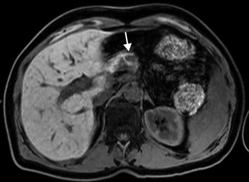 Diseases of the Pancreas 131 a b c d Fig. 3 a-d. Small neuroendocrine neoplasm. a Axial T1-weighted gradient echo (GRE) image (TR/TE 180/4.