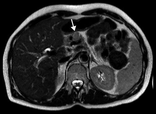 b Axial T2-weighted turbo spin-echo (TSE) image (TR/TE 4,500/102) shows a small neuroendocrine neoplasm that appears hyperintense compared with adjacent parenchyma (arrow).