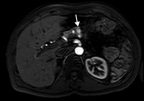 87 ms) during the pancreatic phase of the dynamic study following gadolinium-chelate administration, the neuroendocrine neoplasm appears hyperintense compared with adjacent pancreatic parenchyma