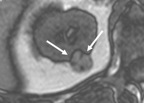 140 L. Aganovic, R.H. Cohan a b Fig. 1 a, b. a Axial opposed-phase T1-weighted magnetic resonance image (MRI) shows hyperintense mass in the upper pole of the left kidney.