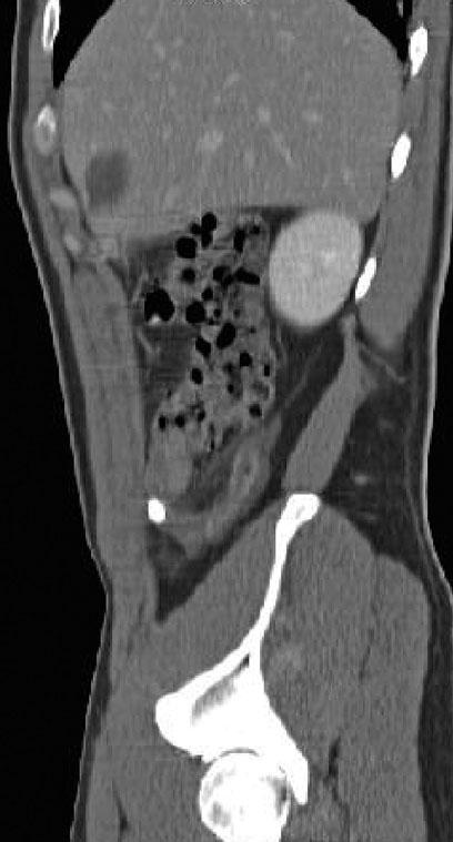 changes of the mesenteric fat (a) exclusion of appendicitis, and for the identification of alternative diagnoses. CT should be reserved as a third-line examination and used only if needed.