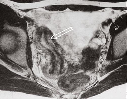 Benign Diseases of the Uterus 155 Fig. 3 Müllerian duct anomalies (MDA): Mayer-Rokitansky-Küster- Hauser Syndrome.