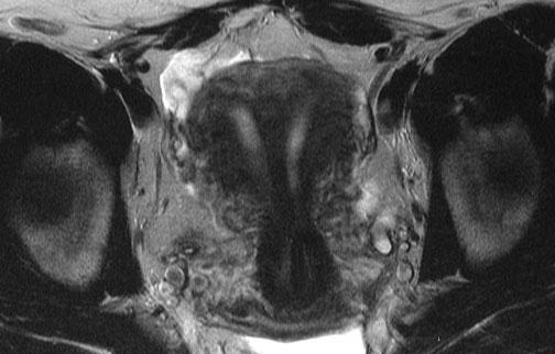 Benign Diseases of the Uterus 157 intraluminal filling defects [17, 18]. Cervical changes include hypoplasia, anterior cervical ridge, cervical collar, and pseudopolyposis [18].