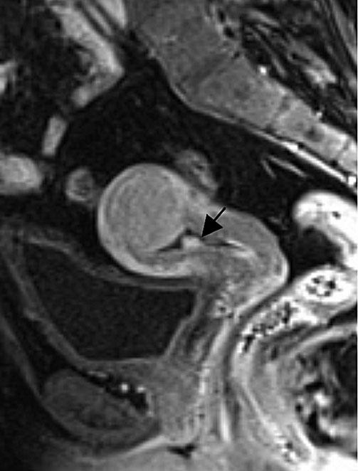 158 S. Ascher, C. Reinhold a Fig. 8. Endometrial polyp. Contrast-enhanced sagittal fat-suppressed T1-weighted magnetic resonance image (MRI) shows an enhancing lower-uterine-segment polyp (arrow).