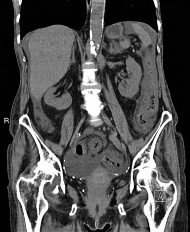 subsequent venous thrombosis. CT findings include a swollen, ovoid, 1.5- to 3.5-cm fat-containing focus with peripheral thickening and associated inflammation.