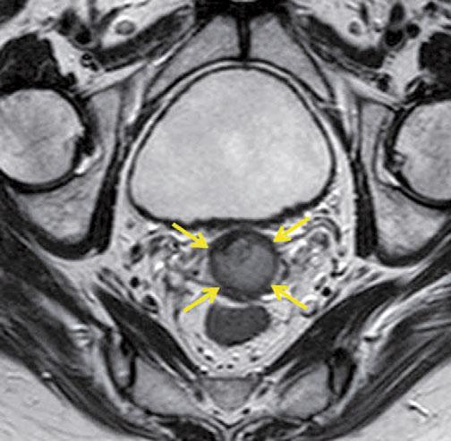 and large stage IIB cancer with breach of the left side of the stromal ring and parametrial invasion (white arrow) Pelvic insufficiency fractures are not uncommon [5], but metastases are very rare.