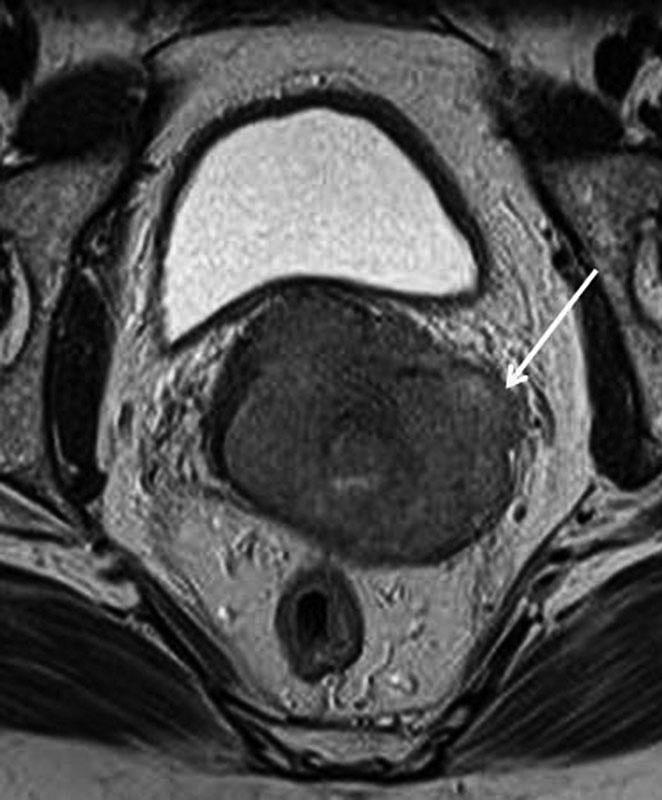 With suspected vesicovaginal and rectovaginal fistulae, T2-WI should include sagittal (Fig. 3b) and inclined axial imaging along the suspected axis of the fistulous track.
