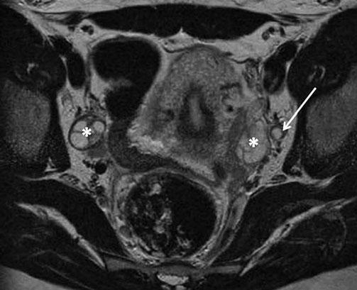 164 H.A. Vargas, J.A. Spencer a b Fig. 3 a, b. a Sagittal T2-weighted image of a large stage II cervical cancer invading the upper vagina and outer wall of the bladder.