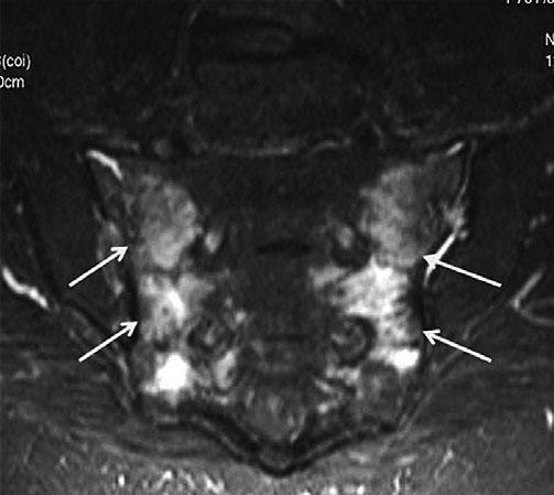Identification of stage II disease may alter surgical approach or anticipate the need for adjuvant brachytherapy. Location of lymph node disease may direct the LND procedure.