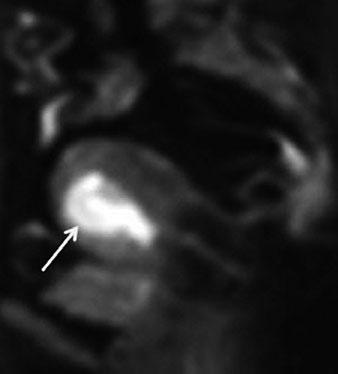 The presence of enlarged regional and/or para-aortic lymph nodes indicates stage IIIC disease.