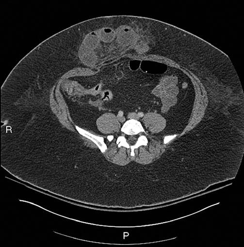 Emergency Radiology of the Abdomen and Pelvis: Imaging of the Nontraumatic and Traumatic Acute Abdomen 11 (SBO) is usually due to adhesions more commonly in patients with previous surgery but
