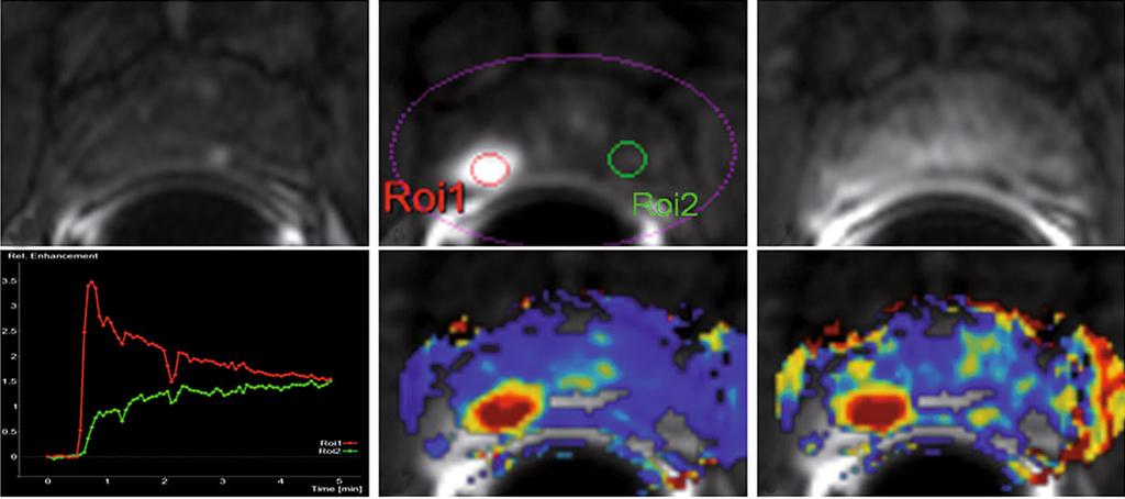 Multiparametric Magnetic Resonance Imaging in Prostate Cancer Detection 183 must be evaluated together with morphological imaging (T2w), especially when assessing the central portions of the prostate