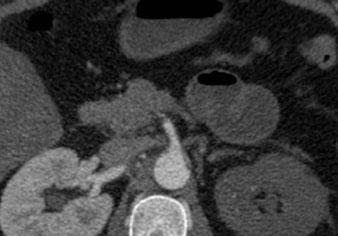 a Computed tomography (CT) demonstrating primary entry tear of type B aortic