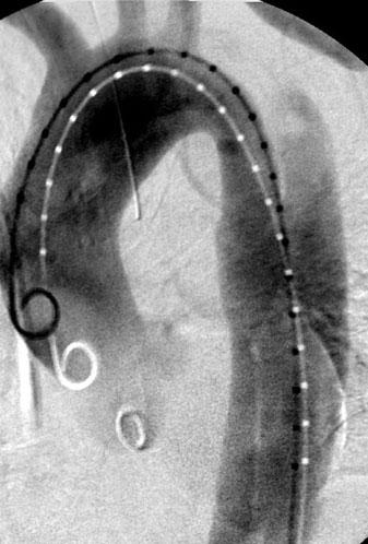 e CT after stent-graft implantation and closure of primary entry tear with false