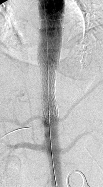 f Aortography post stent-graft implantation demonstrating spontaneous