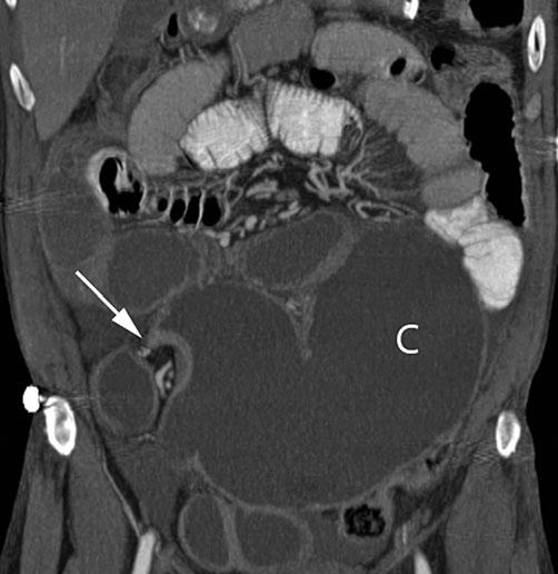 The arrows point to the area of colonic twisting. Note the dilated small-bowel loops due to the proximal colonic obstruction secondary to venous thrombosis is much less common.