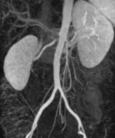 192 J. Lammer a b Fig. 2 a-d. Imaging and intervention in a patient with hypertension due to renal artery stenosis. a Magnetic resonance angiography (MRA) showing stenosis of right renal artery.