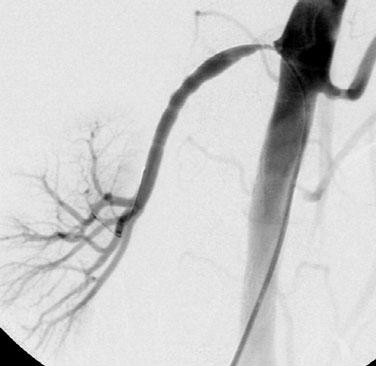 CTA CTA of the renal arteries has a 95% sensitivity to detect RAS and accessory renal arteries.