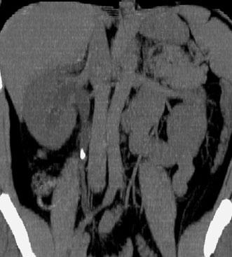 An additional CT acquisition with IVadministered contrast can be obtained as part of the same examination, if time permits, to evaluate the vascular anatomy in more detail and determine whether there