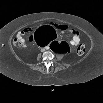 The nonsymptomatic side acts as an intrinsic control, as bilateral ureteral calculi are rare.