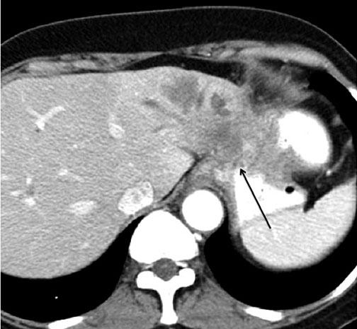 204 J.A. Brink through the gastrohepatic ligament, including gastric and esophageal cancer.