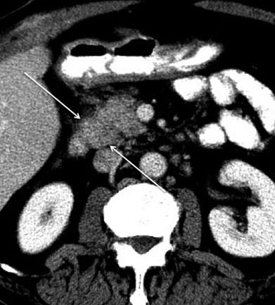 Prospectively, it was unclear as to the organ of origin, but it proved to be a hepatoma extending through the GHL to involve the stomach Gastric disease commonly spreads to the liver and hepatic