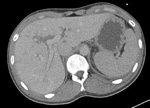 a A 23-year-old female patient after blunt abdominal trauma with liver contusion predominantly affecting the right liver lobe, indicated by periportal edema (or tracking).