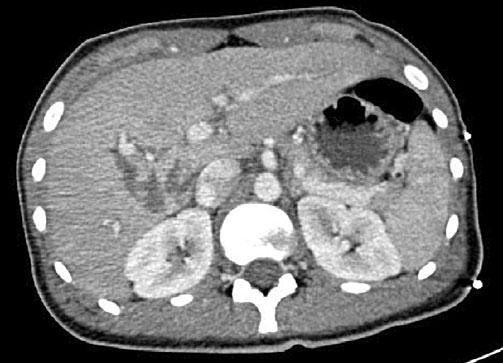 peritoneal cavity, and presence of hemoperitoneum. Late complications include bile leak, biliary stricture, hepatic abscess, delayed hemorrhage, and other vascular complications [10].