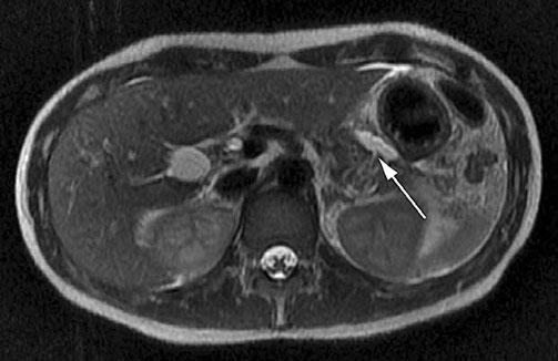 b Suspected main pancreatic duct injury was confirmed on T2-weighted magnetic resonance (MR) imaging, demonstrating the fracture line of the pancreas and a peripancreatic fluid collection