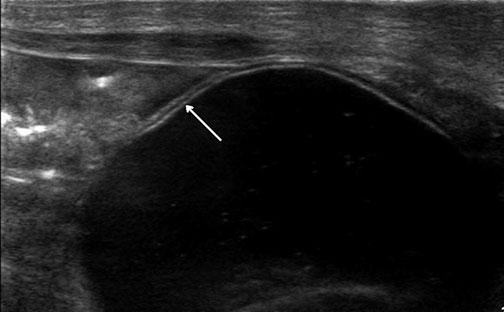 b Postnatal ultrasound (US) image shows gut signature of the cyst wall (arrow); during examination, intrinsic peristalsis of the cyst was seen Three US patterns can be distinguished [28]: Stratified