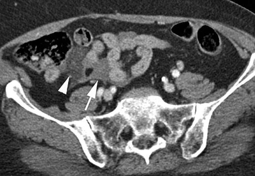 Emergency Radiology of the Abdomen and Pelvis: Imaging of the Nontraumatic and Traumatic Acute Abdomen 15 in hemodynamically unstable patients.