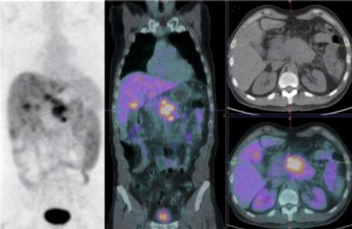 Computed tomography (CT) scan showed stable disease according to Response Evaluation Criteria in Solid Tumors (RECIST) criteria.