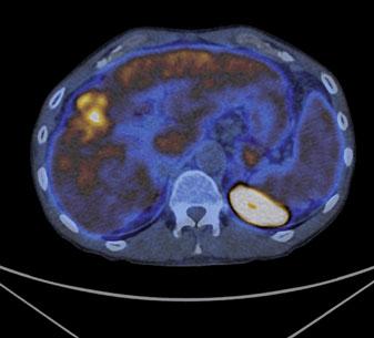 The presence of disease was suspected, and the patient underwent pre - operative positron emission tomography computed tomography (PET/CT) restaging with double-tracer modality.