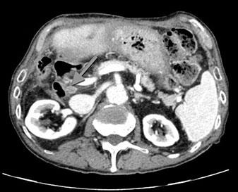 244 S. Fanti, E. Tabacchi, H. Svirydenka, C. Nanni diagnosis, because the tumor remains silent until it is advanced and obstructs the bile duct.