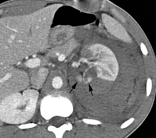 Emergency Radiology of the Abdomen and Pelvis: Imaging of the Nontraumatic and Traumatic Acute Abdomen 19 a b Fig. 19 a, b. Deep (grade III) renal laceration with active extravasation.