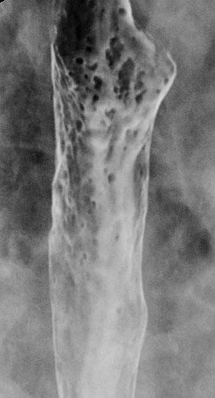 22 M.S. Levine Fig. 1. Candida esophagitis: there are multiple, plaque-like lesions of varying size in the mid esophagus.