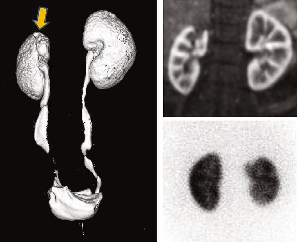 MR Urography in Children 307 a b c Fig. 9 a-c. Cortical renal scarring.