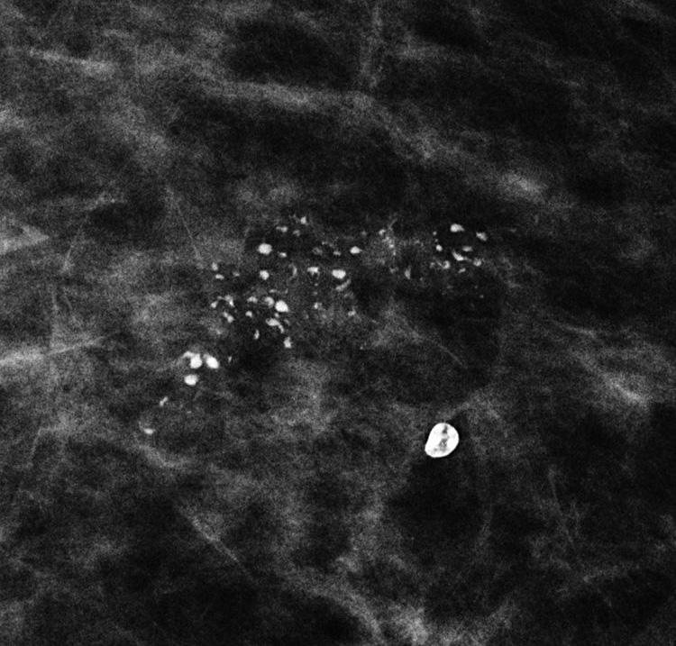 2). Size Oftentimes, breast calcifications are separated into larger (usually benign) macrocalcifications and smaller (possibly malignant) microcalcifications [6].