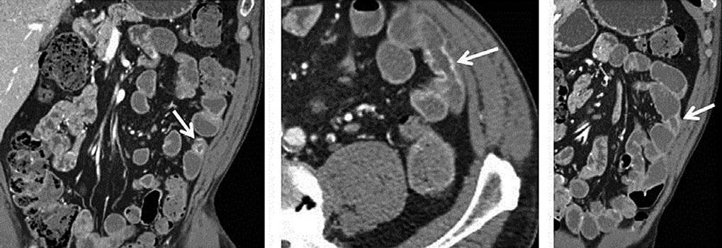 CT Enterography: Small Bowel Imaging That Impacts Patient Management 29 of CT denoising methods can increase the conspicuity of subtle small bowel lesions, such as carcinoid tumors.