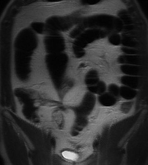 MRI of the Small Bowel 35 seemingly normal wall thickness and contrast enhancement in fibrostenosis mimic normal bowel wall.