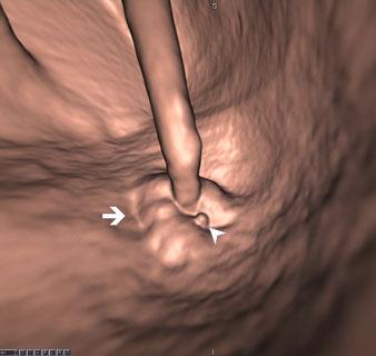 Benign Diseases of the Colon and Rectum: CT Colonography 49 a b Fig. 2 a, b. a Typical 3D image of internal hemorrhoids surrounding the rectal catheter at the level of the anal margin (white arrow).