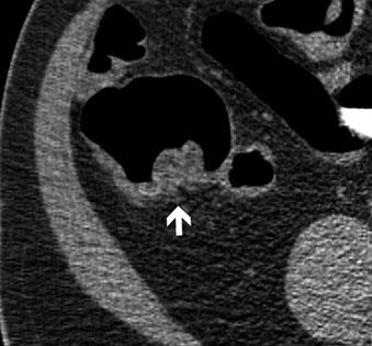 On the background, a spasm with typical contraction of the taeniae gives a triangular appearance to the lumen of the ascending colon (black arrow) Troubleshooting the anorectal region: Take special