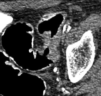 b, d Axial image of the sigmoid showing a shorter segment with wall thickening, without diverticula and with shoulder formation and overhanging edges: malignant stenosing tumor c d folds, are more in