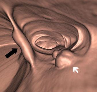 a A 3D view of the sigmoid showing a thickened fold with nodular appearance in a 38-year-old woman with suspicion of endometriosis.