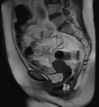 colpocele. An anterior rectocele with rectal invagination is also visible PCL by 3 cm is mild, by 3-6 cm is moderate, and by 6 cm is severe [5, 25-27].