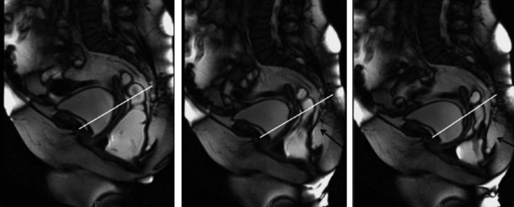 b Progressive straining shows rectal invagination above the rectocele. c Rectal invagination and rectocele are more evident at maximum straining during evacuation a b Fig. 5 a, b.