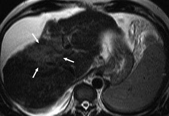 Diffuse Liver Disease: Cirrhosis and Vascular Diseases 81 a b c d e Fig. 3 a-e. a Axial turbo spin-echo T2- weighted magnetic resonance (MR) image shows cirrhotic liver with ascites.