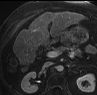 On the other hand, MR imaging with hepatobiliary contrast agents is the only modality that can detect these premalignant lesions [7] and open the window for the treatment of early HCC.