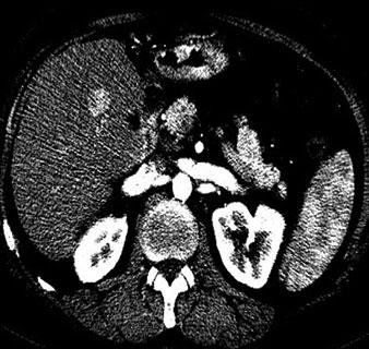 carcinoma. b-d Corresponding dynamic contrast-enhanced computed tomography (CT): b arterial phase; c portal venous phase; d delayed phase.